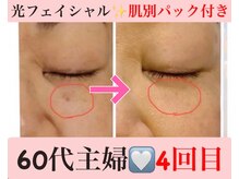 マール(Mar)/ビフォーアフター！シミ/毛穴