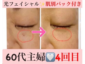 マール(Mar)/ビフォーアフター!シミ/毛穴