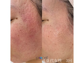 オウジエステサロン(OJIエステサロン)/40代女性　プロセル3回
