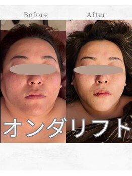 吉乃 大和高田有井店の写真/二重あご・たるみ改善◎フェイスラインすっきり！大和高田で小顔フェイシャル/マイクロウェーブリフト
