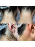 【うなじワックス脱毛】首を長く魅せ美しいアップヘア姿に