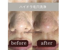 シフォン(Chiffon)/鼻を集中的に洗浄可能！