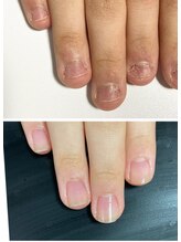 ルカロンネイル(Rukaron Nail)/噛み爪