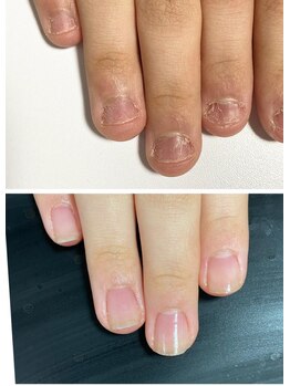 ルカロンネイル(Rukaron Nail)/噛み爪