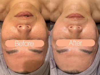 クレヴィア バイ サイバーエステ(CREBIA)/リフトアップ【ポレーション】