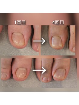 クレセント アイアンドネイル 今泉店(Crescent)/巻き爪ケア