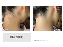 サロン ド メタセコイア(salon de Metasequoia)/【ジュニア脱毛】before／after