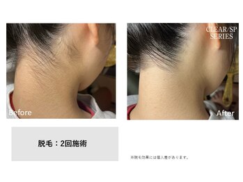 サロン ド メタセコイア(salon de Metasequoia)/【ジュニア脱毛】before／after