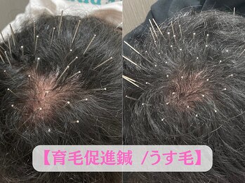 穴田鍼灸整骨院の写真/【育毛促進鍼灸・美容鍼で頭頂部のお悩みにアプローチ!】頭皮に50~100本の鍼を施術し頭皮の血行を促進!