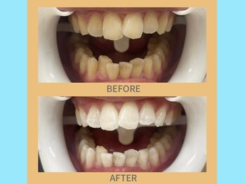 ココティ ホワイトニング(Cocotii)/ビフォーアフター