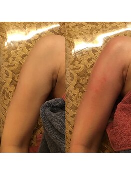 サロン ド シャーロット 恵比寿/カッサコルギ#ハイパ-ナイフ痩身