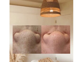 サロンド ユニバース(salon de universe)/黒ずみケア☆