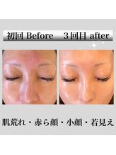 ソレイユ(Soleil)/韓国艶肌☆シミ改善だけじゃない