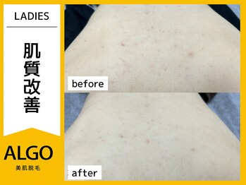 アルゴ 小松店(ALGO)/脱毛だけじゃない！（30代女性）