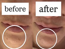 サロン ドロップ 上小田井(Salon drop)/「シミ改善」