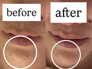 サロン ドロップ 上小田井(Salon drop)/「シミ改善」