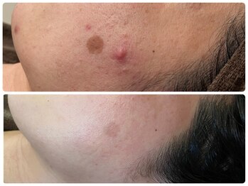 ブリリアント(Brilliant)/シミケア、ニキビケア