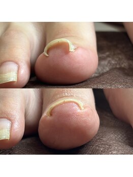 リリ(lili)/巻き爪矯正/1回目/右親指巻き爪