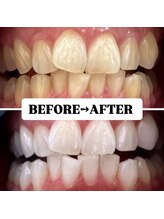 ホワイトニングサロン 豊中/Before&After美白ホワイトニング