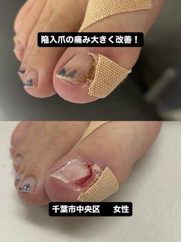 巻き爪じゅん 千葉駅前店/巻き爪じゅん千葉駅前陥入爪施術