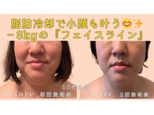 フェイスラインもこんなにスッキリ！小顔で写真映りも◎