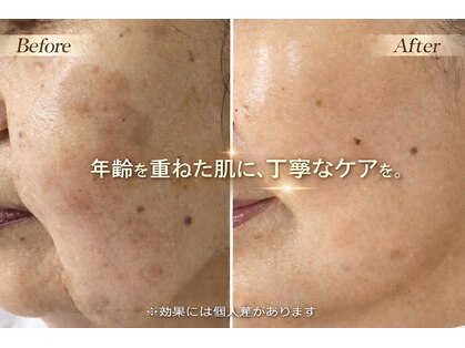 ハクビューティー(HAKU BEAUTY)の写真