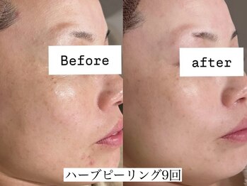 アリス(ALICE)/敏感肌も改善!