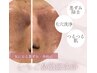 【いちご鼻卒業】鼻の黒ずみ集中洗浄