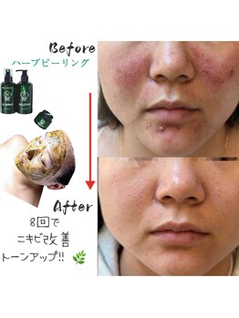 ルミナエステ(LUMINA ESTH)/ハーブピーリング/川口