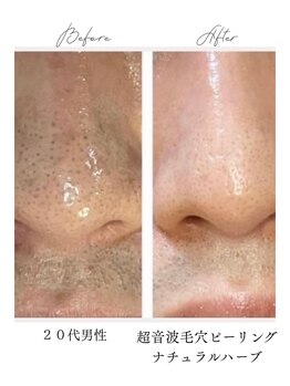 アルト(ALTO)の写真/【天神橋筋六丁目駅1分】お肌の状態に合わせた施術をご提案◎完全プライベート空間で本気の毛穴ケアを♪