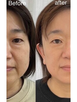 ココロニコル 今治店/今治初　幹細胞肌育成ケアLit