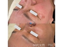 オウジエステサロン(OJIエステサロン)/50代女性　プロセル7回