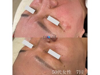 オウジエステサロン(OJIエステサロン)/50代女性　プロセル7回