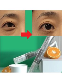 リラ プラス(Lila+)の写真/【目元たるみシワ根本改善】サロン本格EGFケア×自宅で続くアイロンクリームで感動を♪初めての方も◎