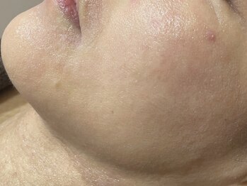 アンドユー ヨコハマ(&U Yokohama)/クリスティーナ施術1回後