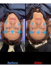 松戸駅前鍼灸院 整骨院/歪み/小顔/むくみ/リフトアップ