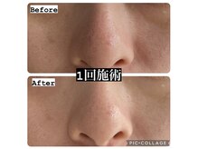 リノ(Lino)/美白/くすみ/毛穴◎お顔のパック