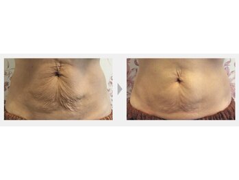 Nビューティー/最新RFサーモシェイプオーパス