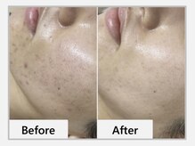 エマクラン(emmaclan)/