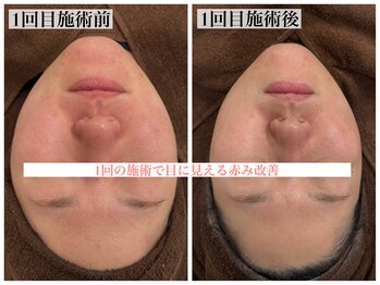 テンニック(10nick)/1回での効果が高い