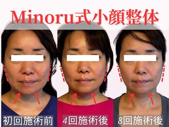 フレキシボディ(FlexiBody)/小顔施術ビフォーアフター #14