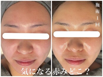 ダン(dan)/【陶肌トリートメント】症例