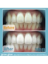 グロウ グロウ(grow.glow)/医療提携ホワイトニング