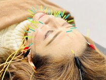 桐生ひろさわ整骨院/美容鍼２