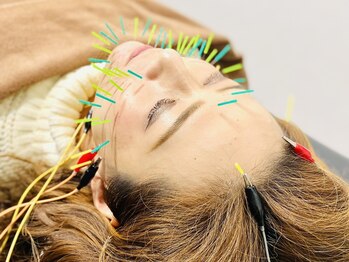 桐生ひろさわ整骨院/美容鍼2