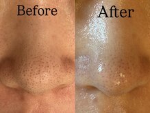 ビューティービレッジ(Beauty village)/大人気！毛穴洗浄フェイシャル