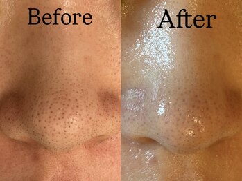 ビューティービレッジ(Beauty village)/大人気！毛穴洗浄フェイシャル