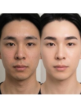 眉毛Winsome吉祥寺アイブロウ眉毛サロン/眉毛/メンズ眉毛サロン/メンズ眉毛アイブロウの写真/毛穴ケアで垢抜け肌へ☆◇毛穴洗浄で黒ずみ除去して清潔感UP！［メンズ眉毛サロン/メンズアイブロウ］