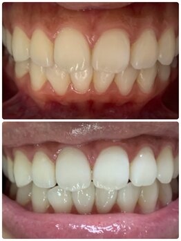 ラブホワイトニング 渋谷店(LOVEホワイトニング)/芸能人御用達