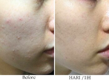 ビボーラ(BEBEAURA)/☆HARIトリートメント☆